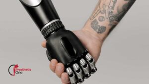 Advancements in Hand Prosthetics