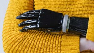 Who Requires a Hand Prosthesis